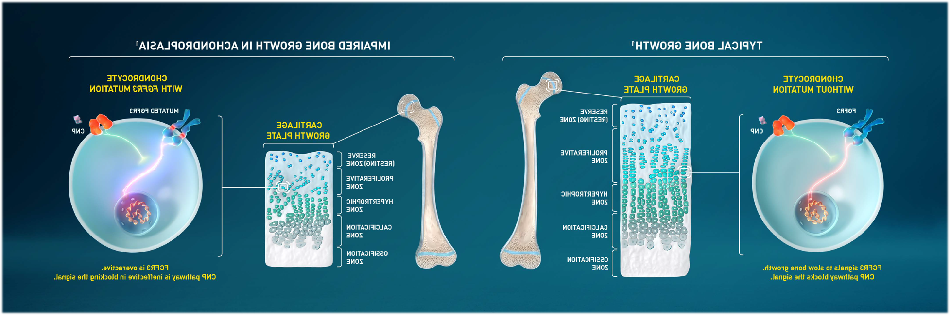 Image: Normal Bone Growth vs. Bone Growth with Achondroplasia